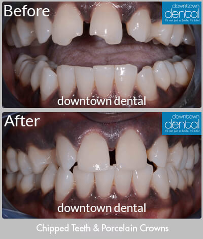 Chipped Front Teeth Before & After Results - Los Angeles, CA