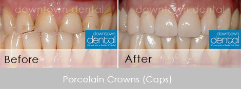 Crowns Before After 13