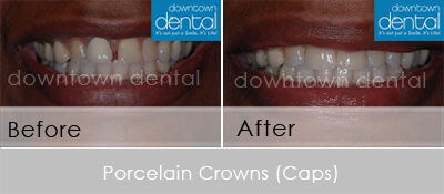 Crowns Before After 03