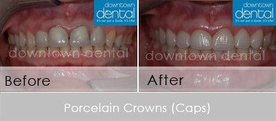 Crowns Before After 04