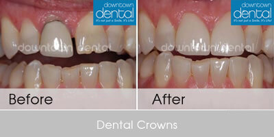 Crowns Before After 08
