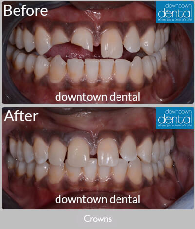 Crowns Before & After Results