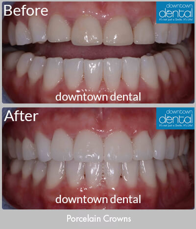 Porcelain Crowns Before & After Results - Los Angeles, CA