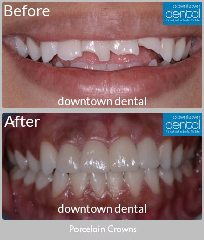 Porcelain Crowns Before & After Results - Los Angeles, CA