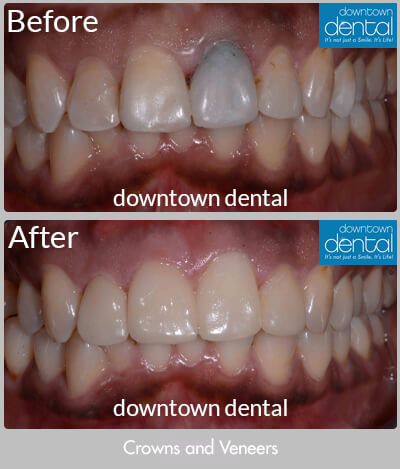 Crowns and Veneers Before & After Results