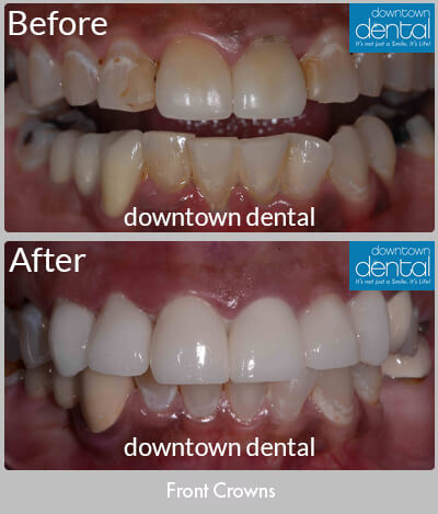 Front Crowns Before & After Results - Los Angeles, CA