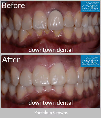 Two Porcelain Crowns Before & After Results - Los Angeles, CA