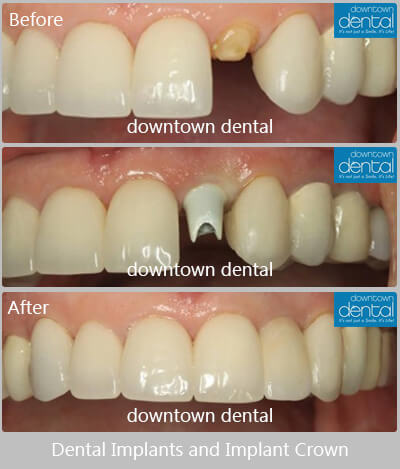 Dental Implant Before After 11
