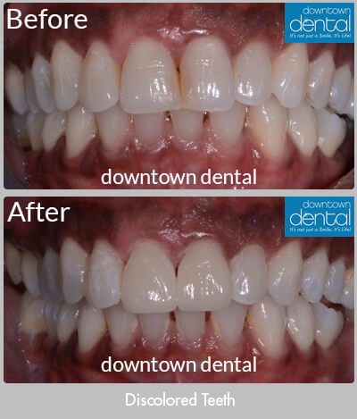 Discolored Front Teeth Before & After Results - Los Angeles, CA