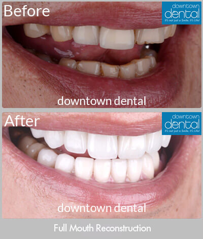 Full Mouth Reconstruction Before & After Results - Los Angeles, CA