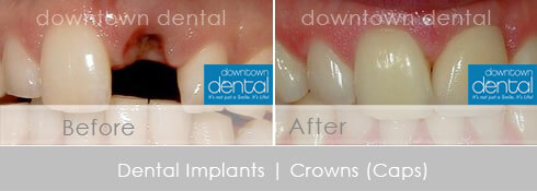 Implant Before After 01