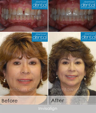 Invisalign Before After