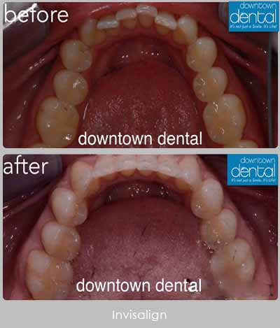 Invisalign Treatment Before After