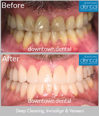 Deep cleaning, Invisalign & Veneers Before & After Results - Los Angeles, CA