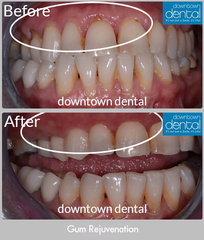 Gum Rejuvenation Before & After Results - Los Angeles, CA
