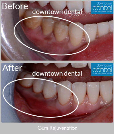 Gum Rejuvenation Before & After Results - Los Angeles, CA