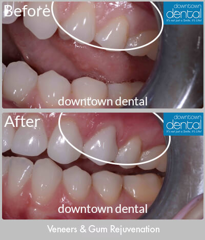 Veneers & Gum Rejuvenation Before & After Results - Los Angeles, CA