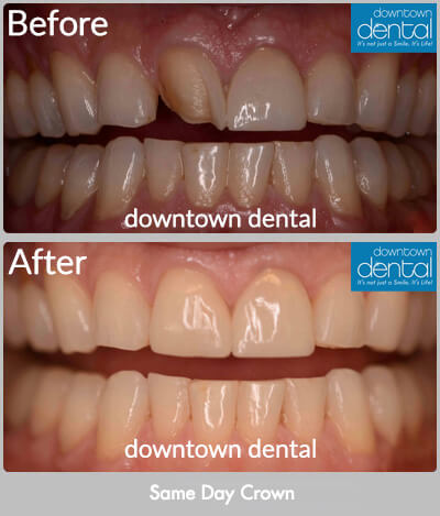 Same Day Crowns Before & After Results - Los Angeles, CA