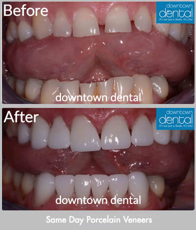Same Day Porcelain Veneers Before & After Results - Los Angeles, CA