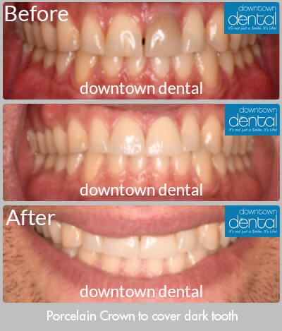 Oral Retractors Before & After Results - Los Angeles, CA