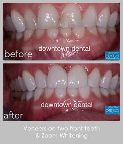 Veneers 8&9 and Zoom Whitening Before After 01