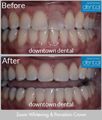 Zoom Whitening & Porcelain Crown Before & After Results - Los Angeles, CA