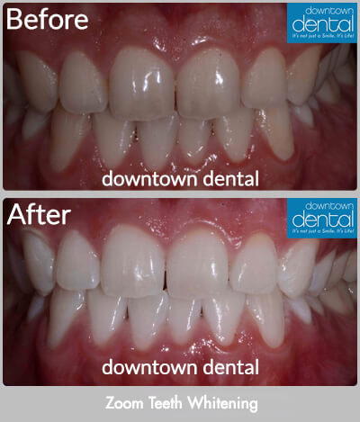 Zoom Teeth Whitening Before & After Results - Los Angeles, CA