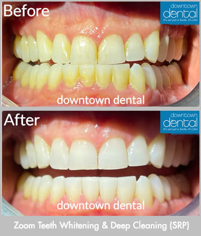 Zoom Teeth Whitening & Deep Cleaning Before & After Results - Los Angeles, CA