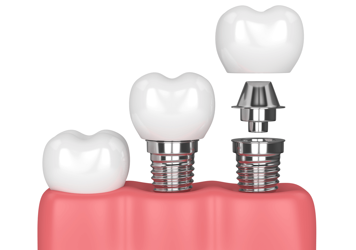 Learn More About Advantages of implant dentistry Downtown in Los Angeles, CA
