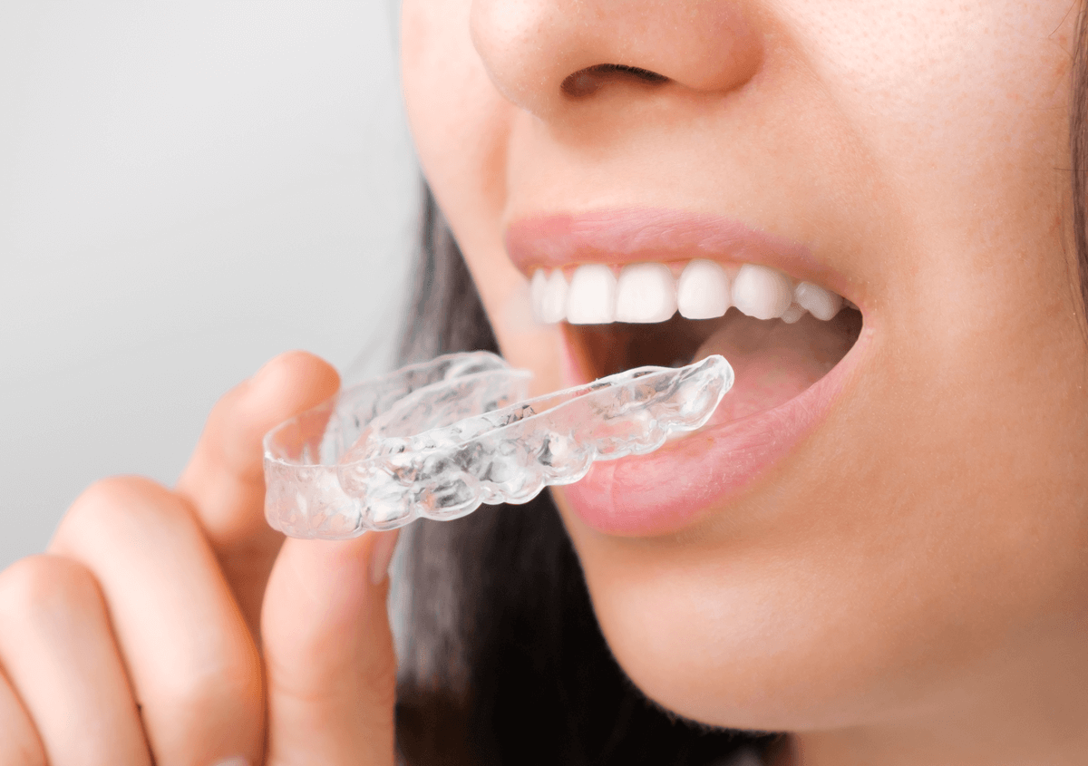 Learn More About Benefits of Invisalign In Los Angeles, CA