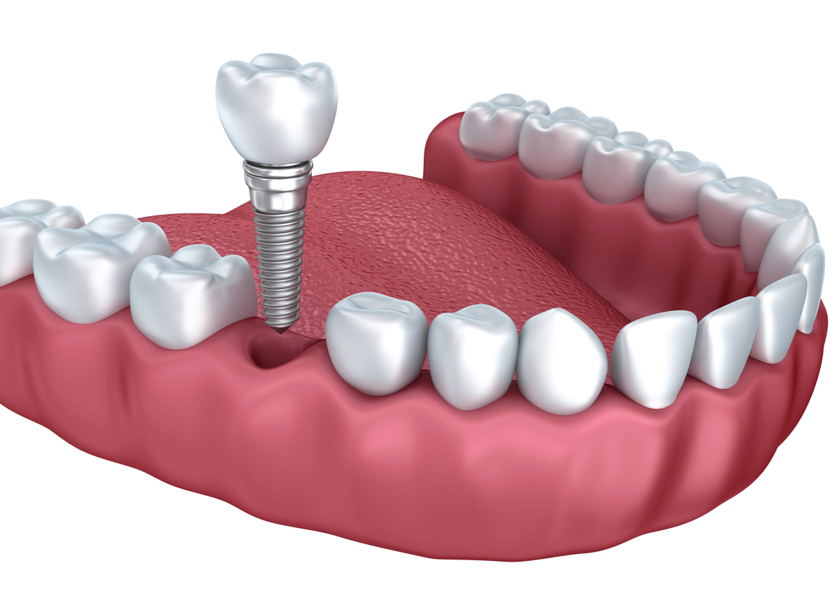 Learn More About dentures in Los Angeles, CA