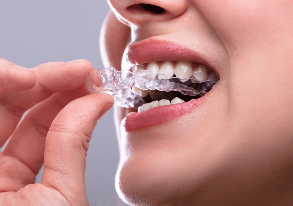 Learn More About Invisalign treatments In Los Angeles, CA