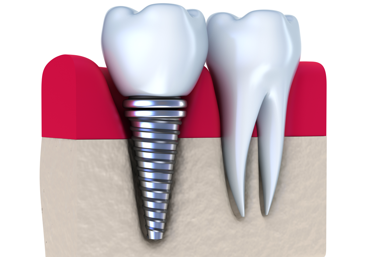 Learn More About Titanium Dental Implants In Los Angeles, CA