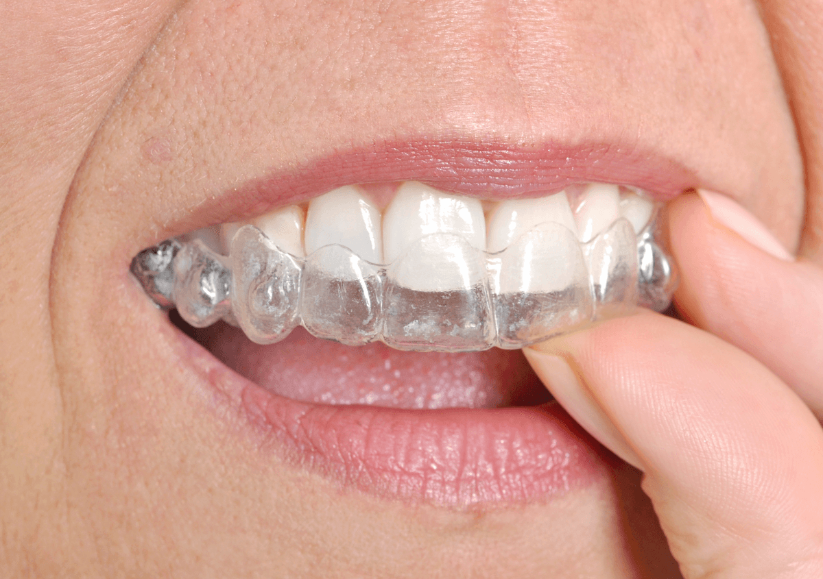 Learn More About how do Invisalign trays work In Los Angeles, CA