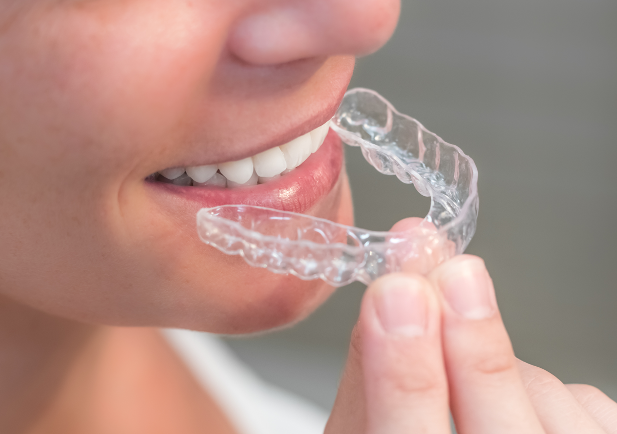 The Best Invisalign treatments Near Me in Los Angeles, CA