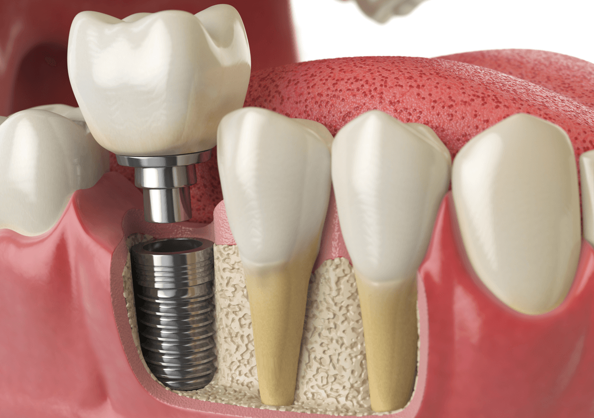 Learn More About candidate for dental implant in Downtown in Los Angeles, CA