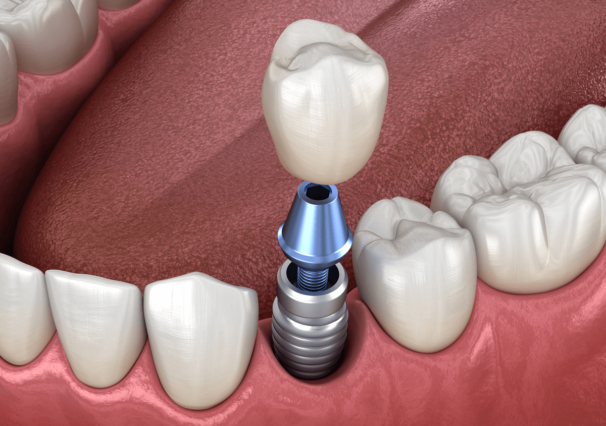 The Best Dental implant solutions in Los Angeles, CA