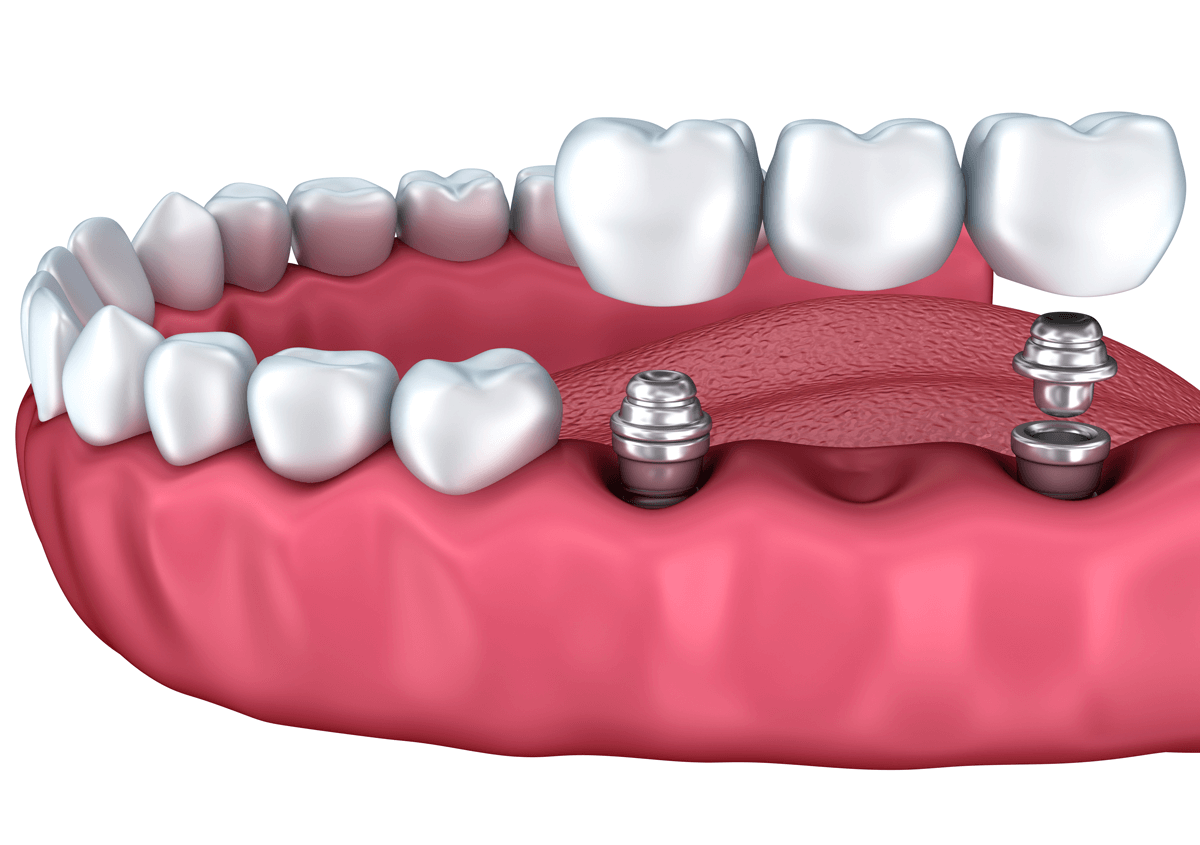 The Best dental implant Solution in Los Angeles, CA