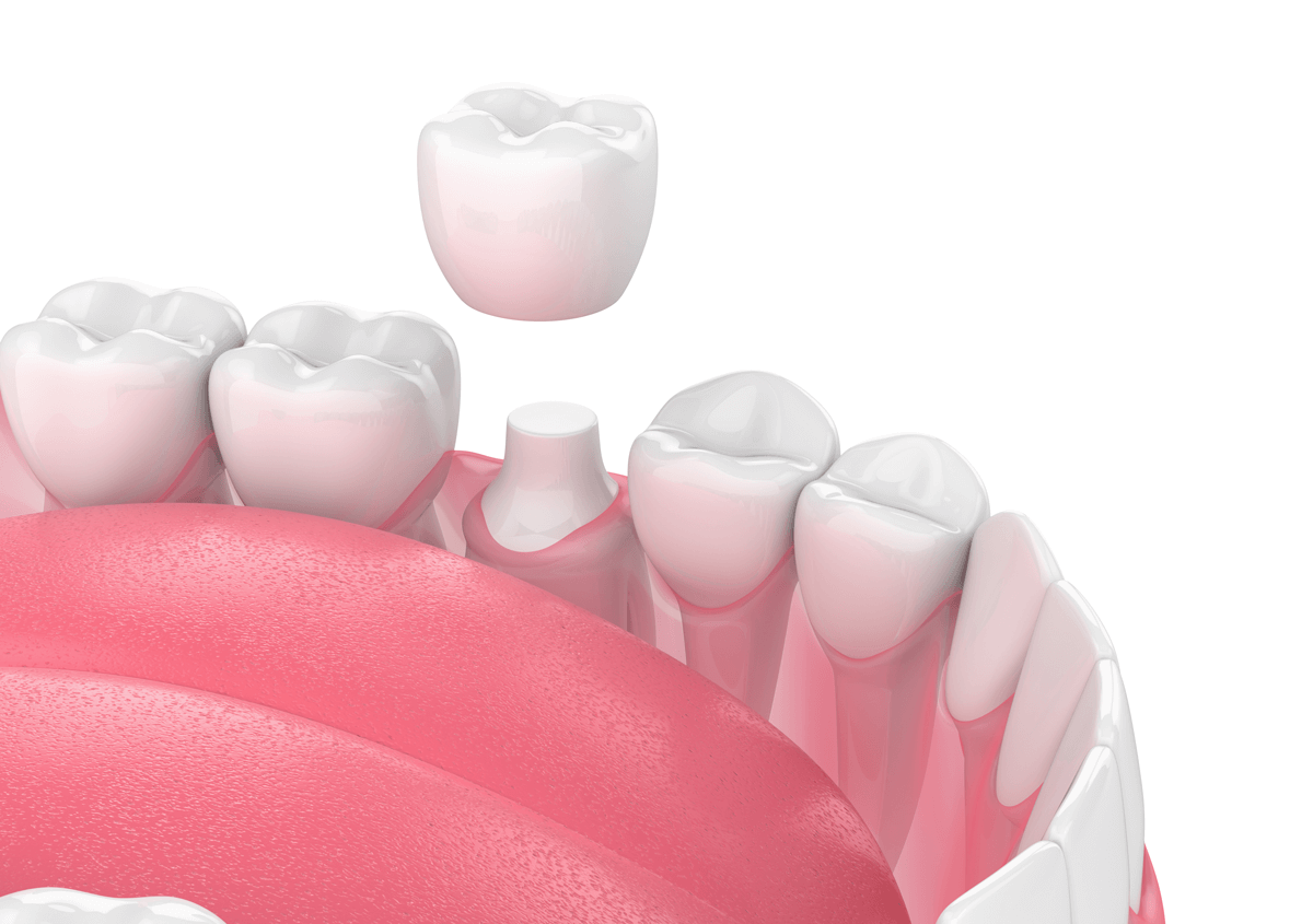When is a Dental Crown Necessary in Los Angeles, CA
