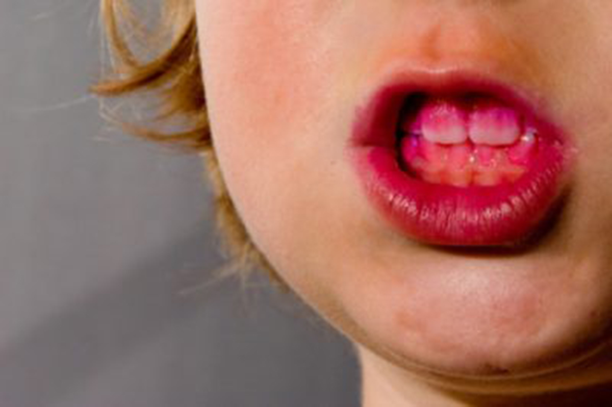 child with gum disease