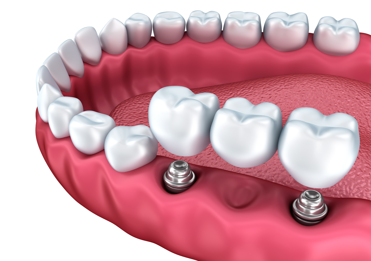 dental crowns, contributing to a beautiful smile in Los Angeles, CA