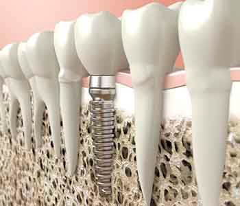Dental Implants Los Angeles CA