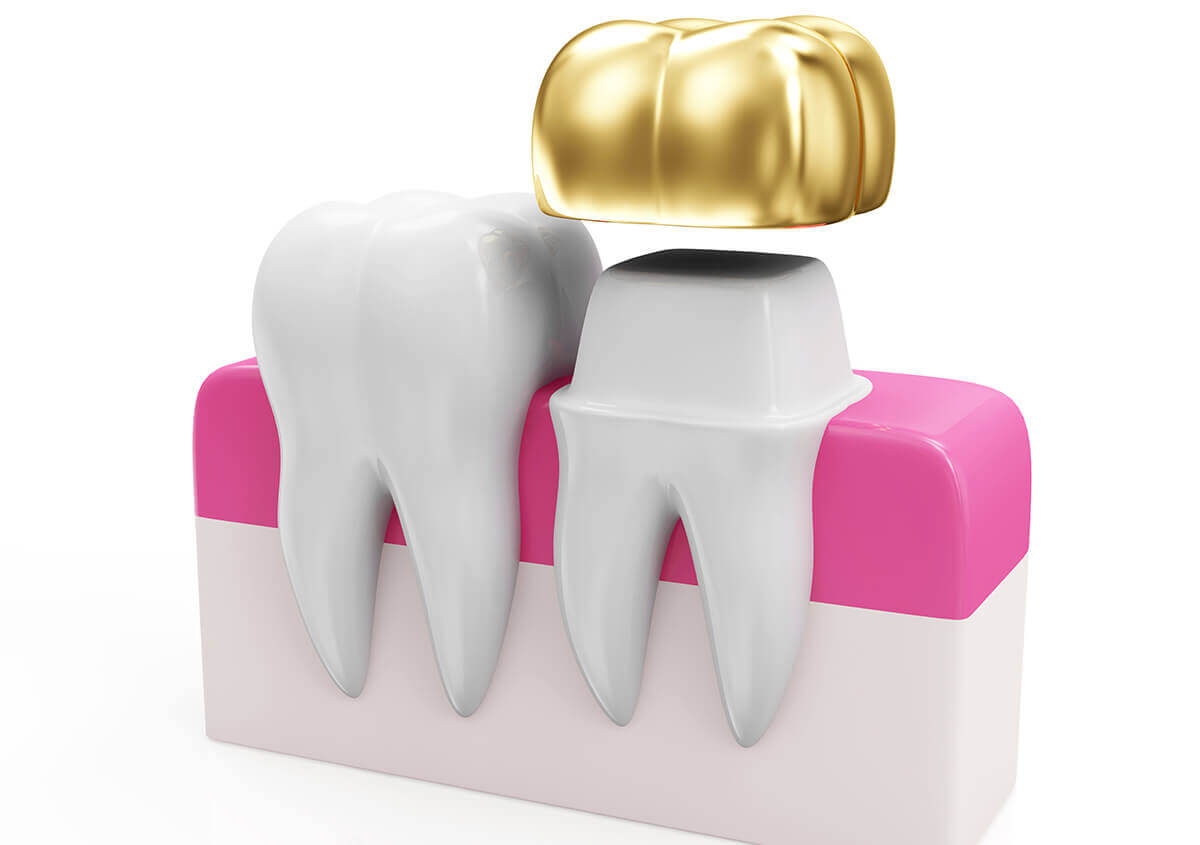 Dental Crown Cost Near Los Angeles Area