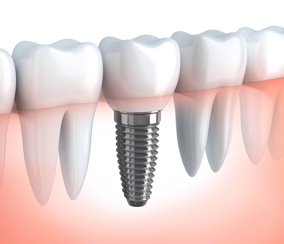 Implant Dentistry in Los Angeles Area