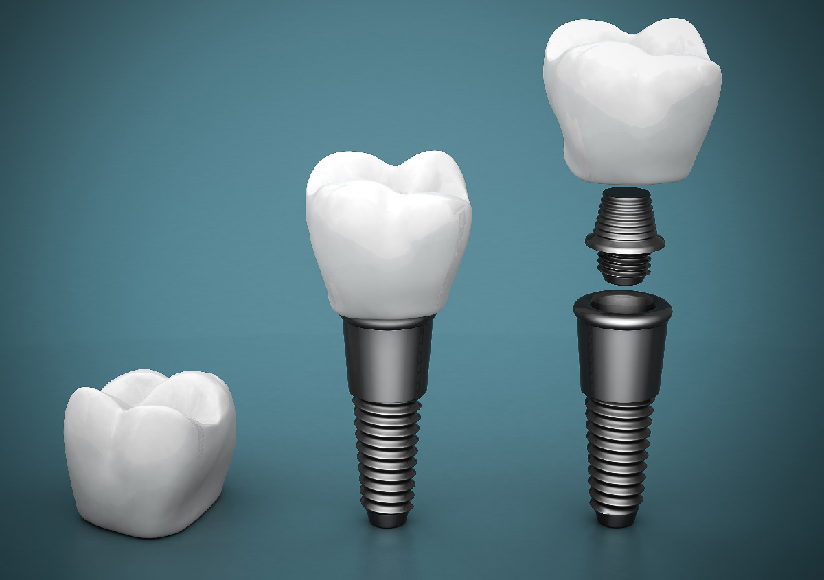 Comparing tooth replacement options in Los Angeles CA area