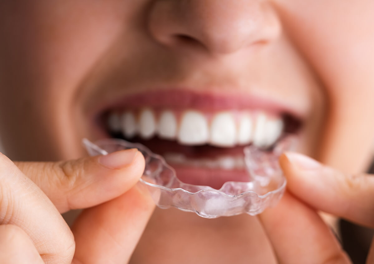 Invisible Braces for Adults in Los Angeles California Area