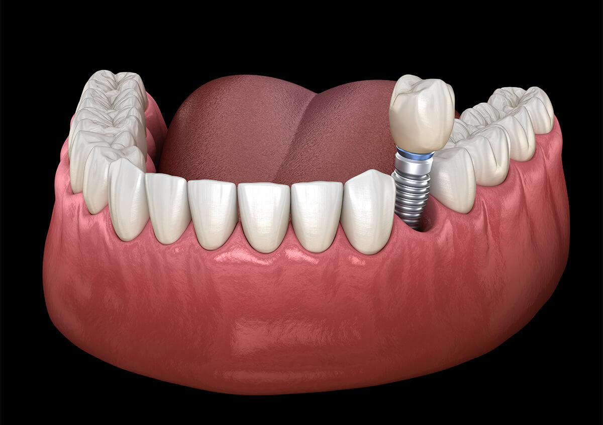 Dental Implant Surgery in Los Angeles CA Area